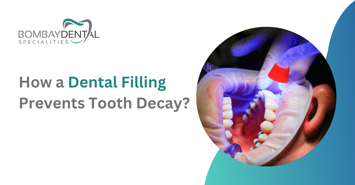 How a Dental Filling Prevents Tooth Decay?