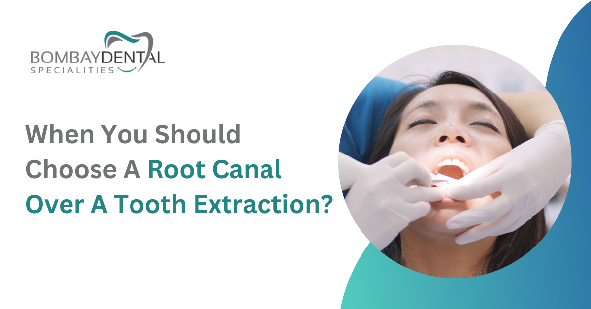 When You Should Choose A Root Canal Over A Tooth Extraction?