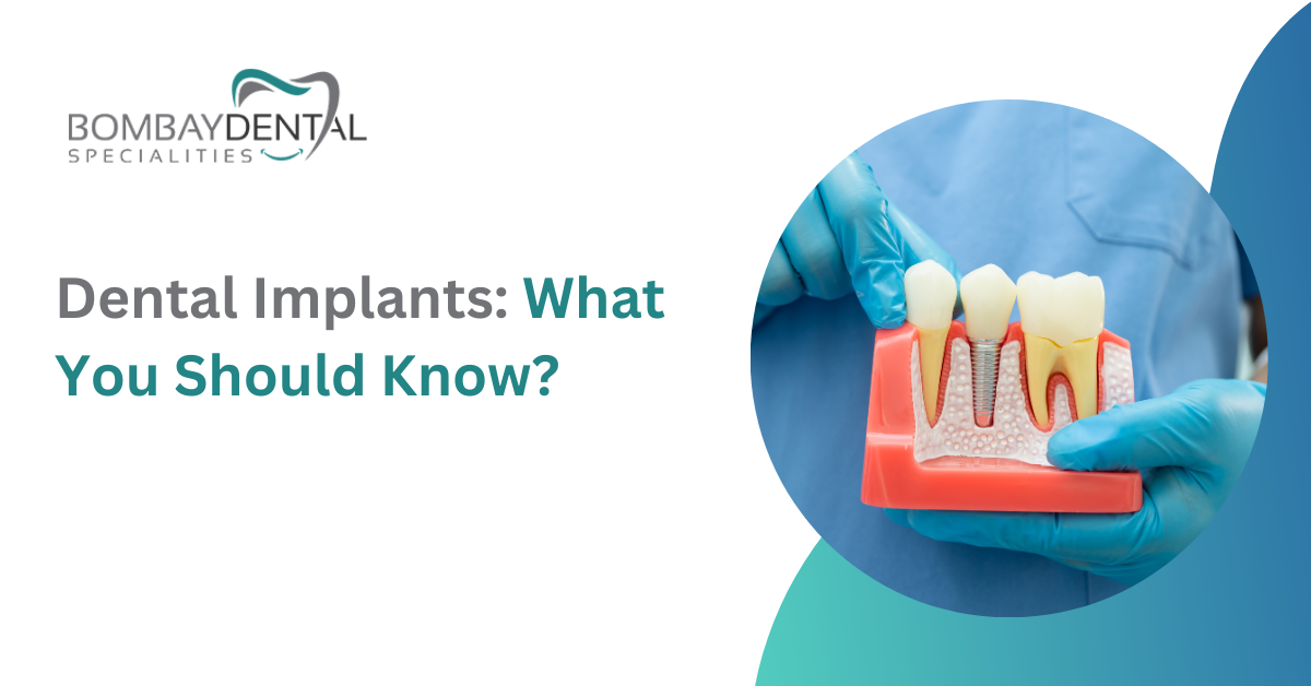 Dental Implants: What You Should Know?