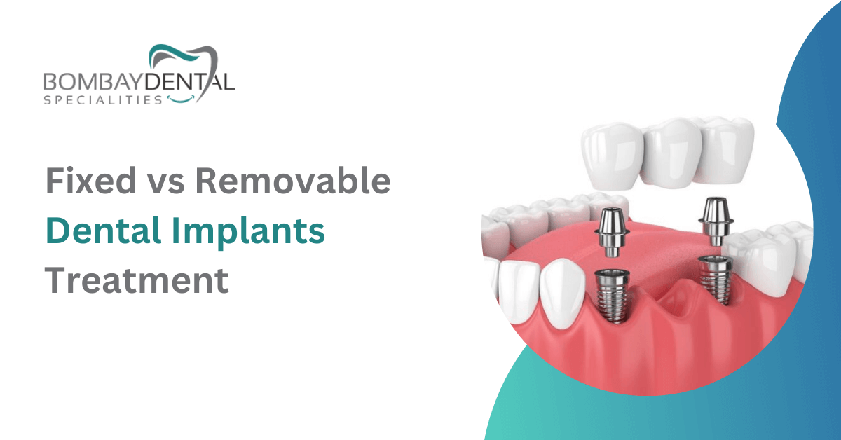 Fixed vs Removable Dental Implants Treatment